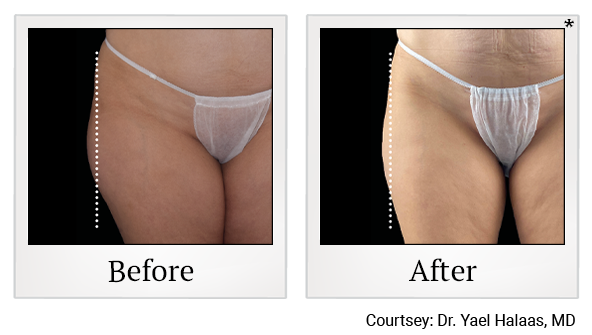 Results 10 of emsculpt neo treatment at Rêve Body Sculpting in Louisville