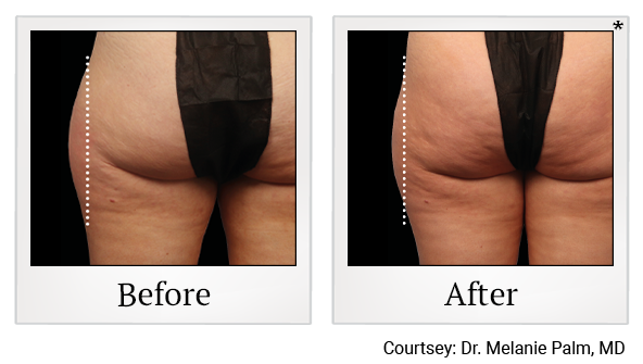 Results 11 of emsculpt neo treatment at Rêve Body Sculpting in Louisville