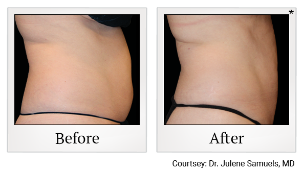 Results 12 of emsculpt neo treatment at Rêve Body Sculpting in Louisville