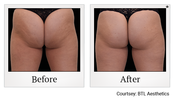 Results of Emsculpt NEO treatment at Rêve Body Sculpting in Louisville