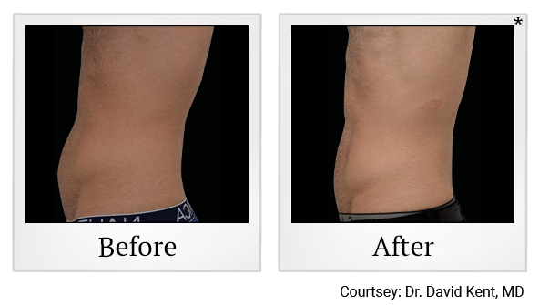 Results of Emsculpt NEO treatment at Rêve Body Sculpting in Louisville