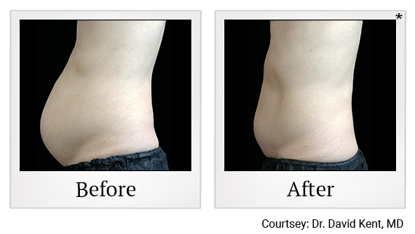 Results of Emsculpt NEO treatment at Rêve Body Sculpting in Louisville