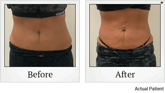 Results 11 of LED Light treatment at Rêve Body Sculpting in Louisville