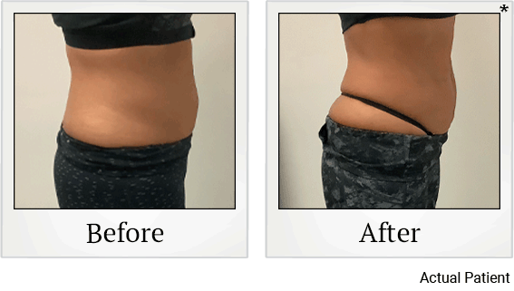 Results 12 of LED Light treatment at Rêve Body Sculpting in Louisville