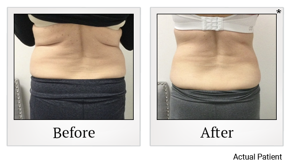 Results of LED Light treatment at Rêve Body Sculpting in Louisville