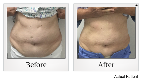 Results of LED Light treatment at Rêve Body Sculpting in Louisville