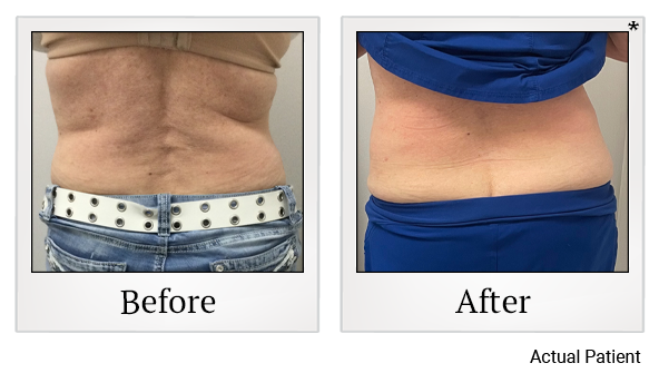 Results of LED Light treatment at Rêve Body Sculpting in Louisville