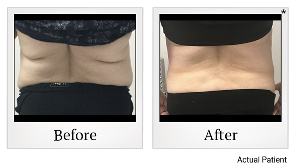 Results 7 of LED Light treatment at Rêve Body Sculpting in Louisville