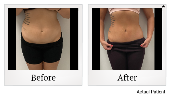 Results 8 of LED Light treatment at Rêve Body Sculpting in Louisville