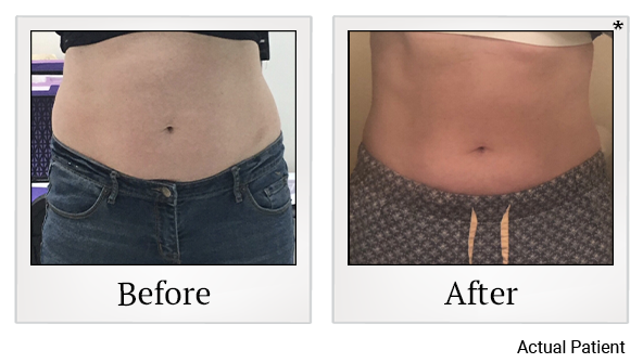 Results 9 of LED Light treatment at Rêve Body Sculpting in Louisville